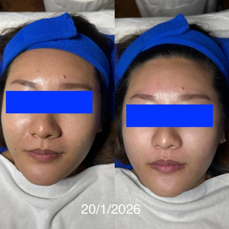 Dullness, big pores