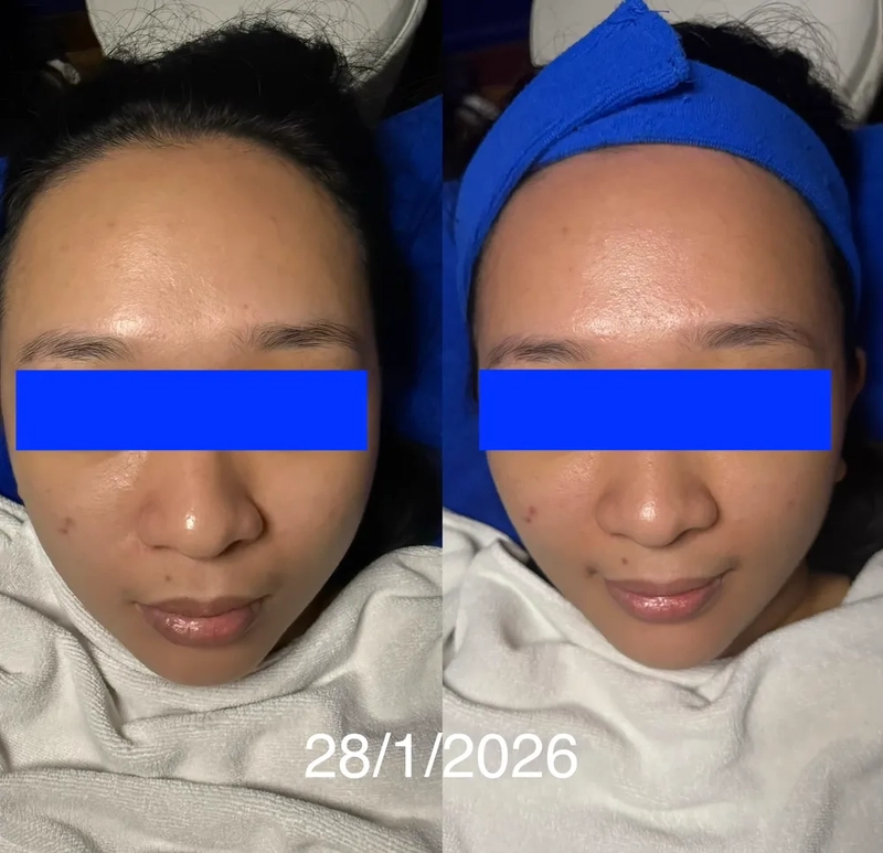 Dullness, acne marks