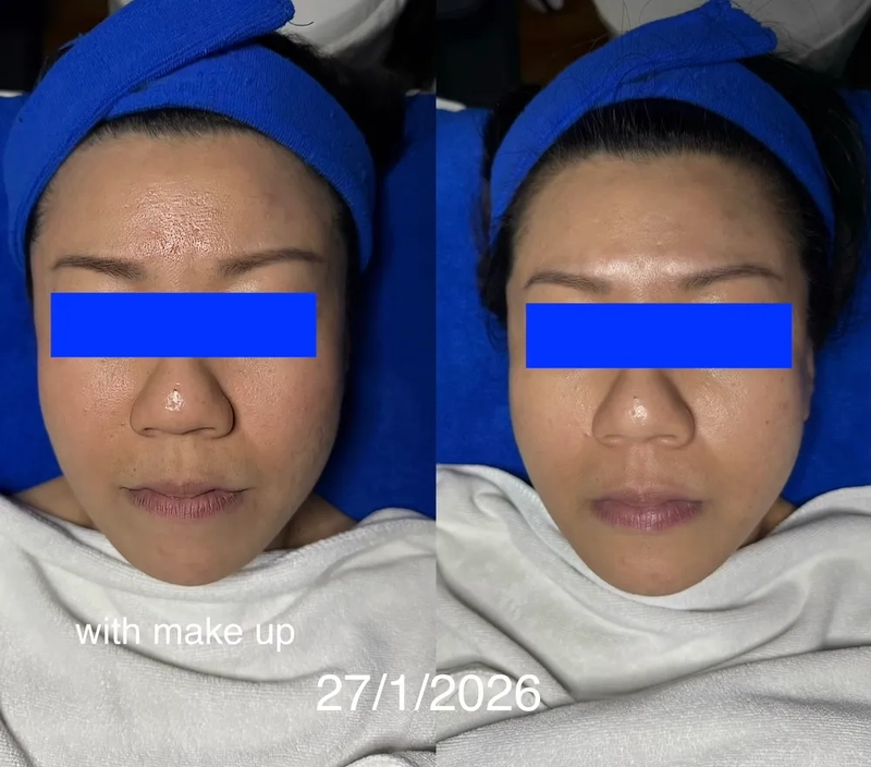 Dullness, big pores
