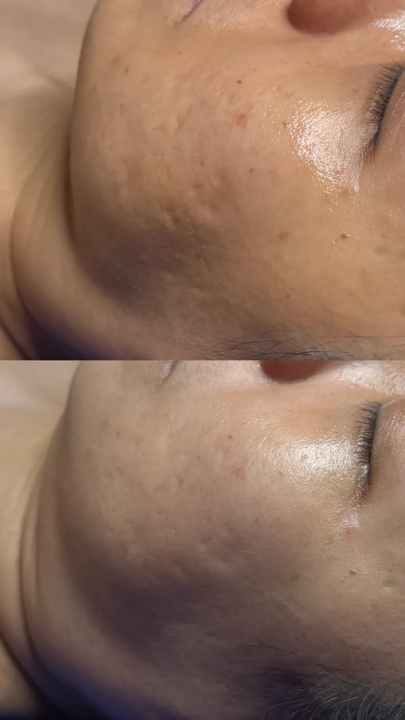 Long term acne scar