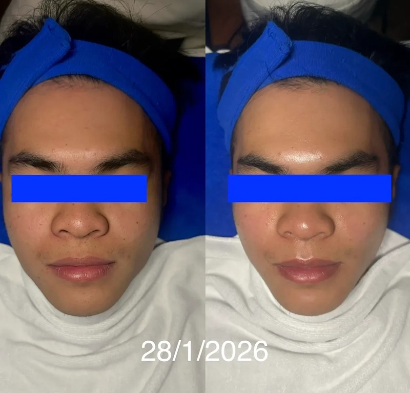Redness, sensitive skin