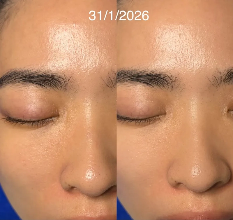 Skin bumps, big pores