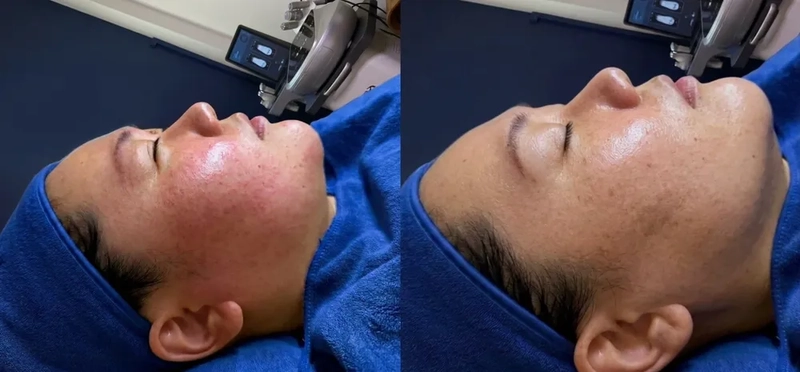 Damaged skin barrier