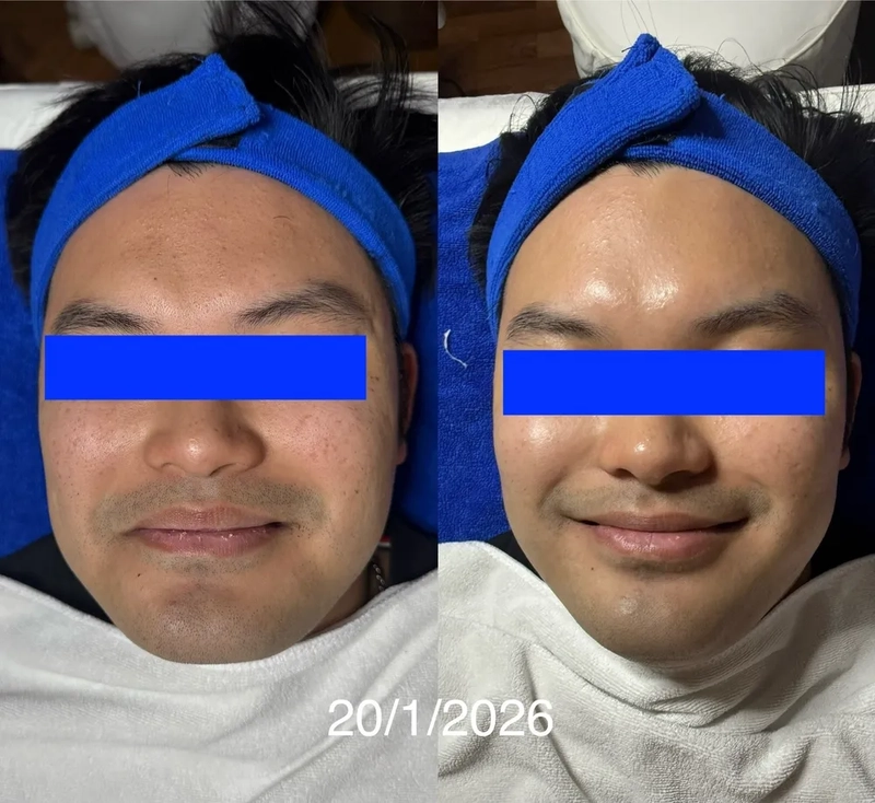 Skin bumps, skin layer built up